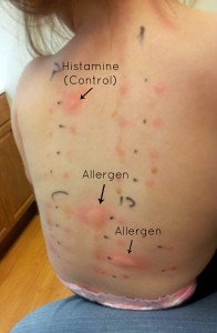 Allergy-test2
